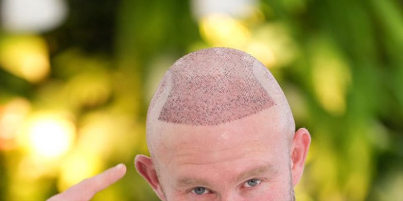 How Much Is a Hair Transplant in Turkey - Itemised Costs, Real Quality